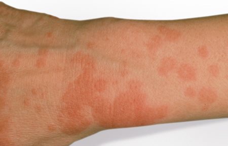 Woran Sie Eine Sonnenallergie Erkennen Stern De Woran Sie Eine Sonnenallergie Erkennen Stern De